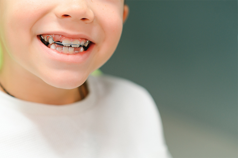 Additional Orthodontic Appliances in Monsey