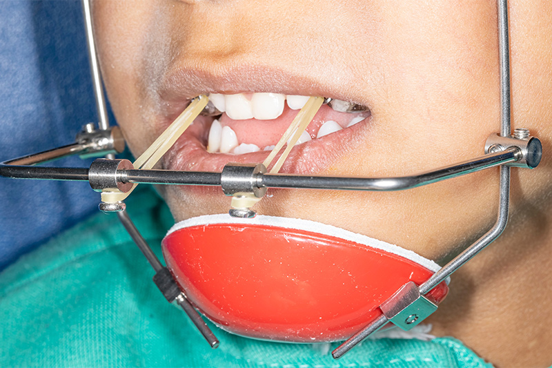 Additional Orthodontic Appliances in Monsey