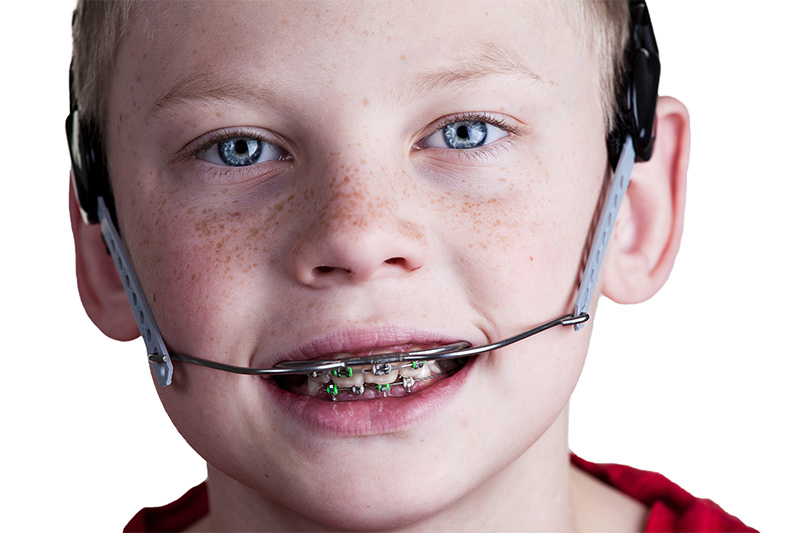 Additional Orthodontic Appliances in Monsey