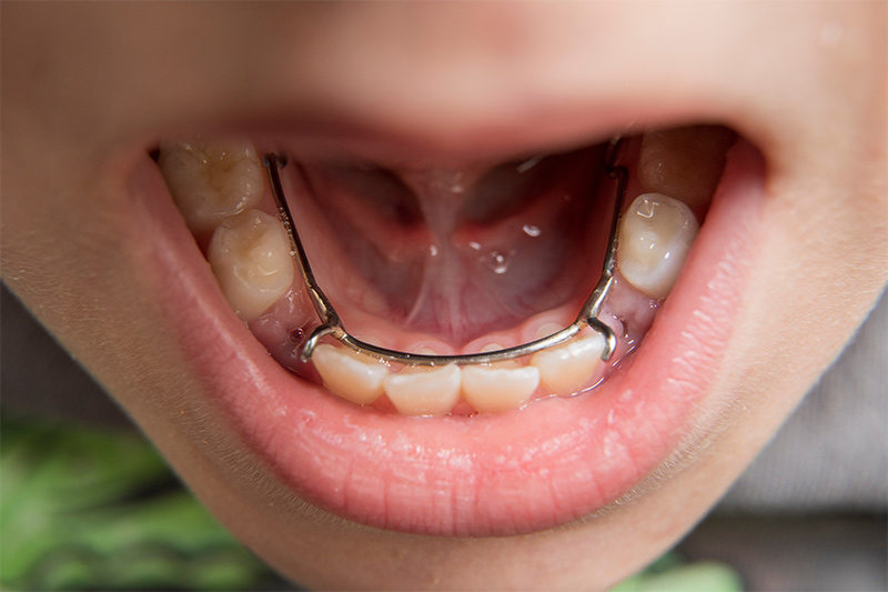 Additional Orthodontic Appliances in Monsey