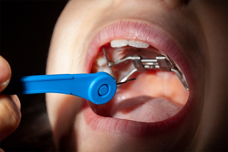 Additional Orthodontic Appliances in Monsey