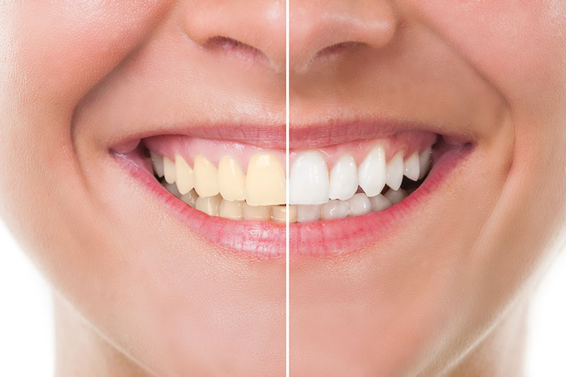 Teeth Whitening in Monsey
