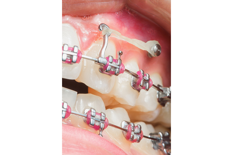 Additional Orthodontic Appliances in Monsey