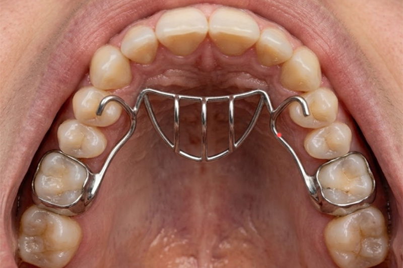 Additional Orthodontic Appliances in Monsey